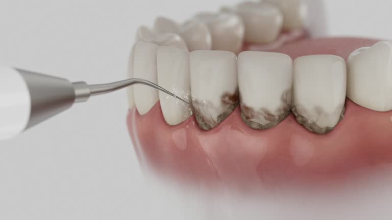 Reliable Tooth Extraction contractor in Oakville, MO by Smile Center Dentistry